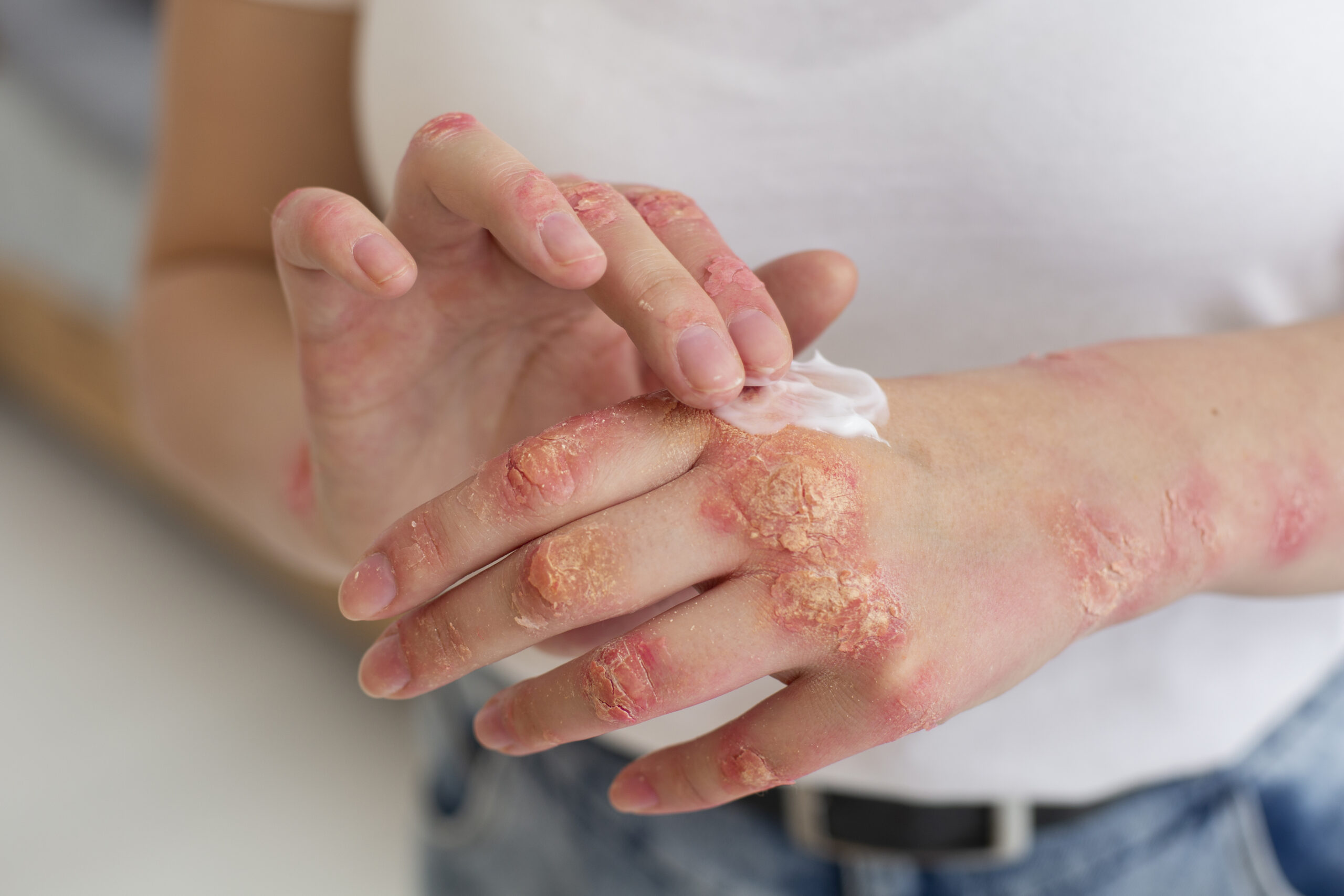 hands-patient-suffering-from-psoriasis (1) hands-patient-suffering-from-psoriasis (1)