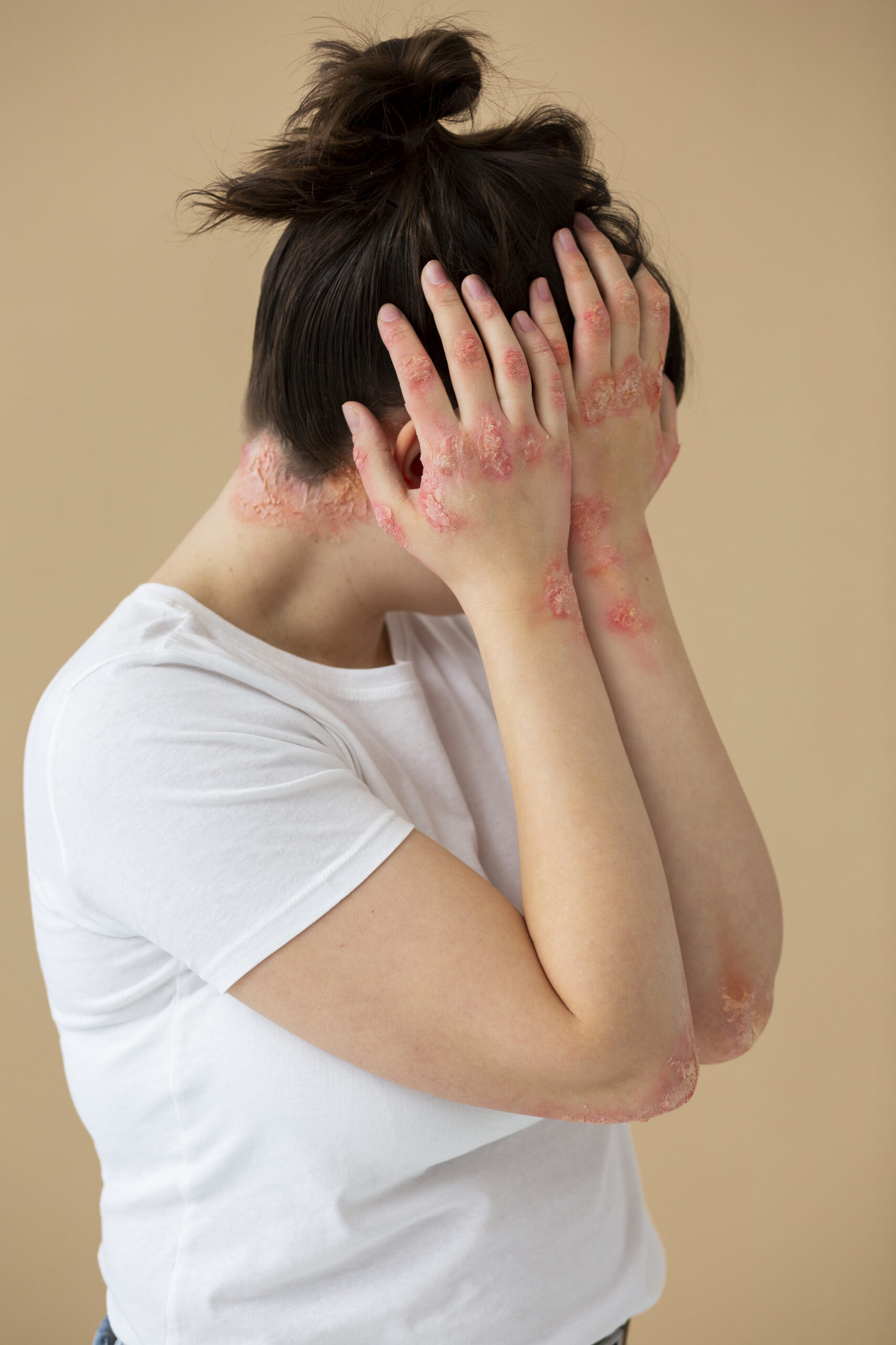 hands-patient-suffering-from-psoriasis hands-patient-suffering-from-psoriasis